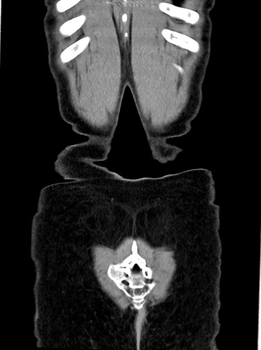 Abdominal wall and retroperitoneal tuberculosis (Radiopaedia 88137-104729 Coronal C+ portal venous phase 98).jpg