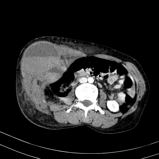 File:Abdominal wall hematoma with active bleeding (Radiopaedia 83915-99117 Axial renal cortical phase 45).jpg