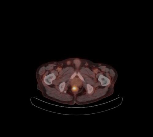 Abdominal wall metastasis from colorectal carcinoma (Radiopaedia 31016-31719 C 18).jpg