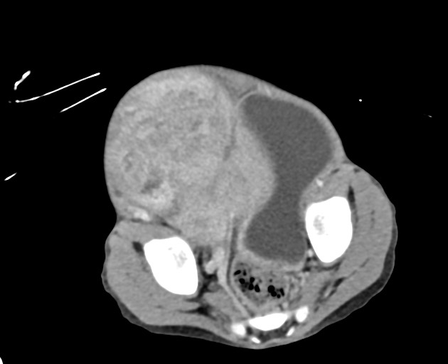 Abdominopelvic rhabdomyosarcoma (Radiopaedia 78356-90984 Axial C+ portal venous phase 138).jpg