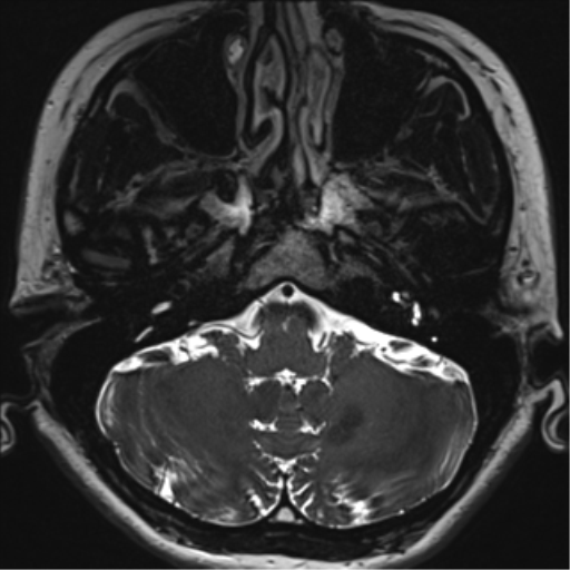 Abducens nerve palsy (Radiopaedia 51069-56648 Axial T2 fat sat 11).png