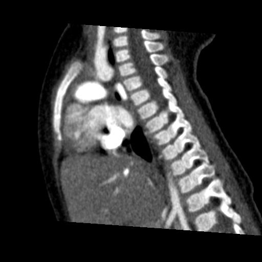 Aberrant left pulmonary artery (pulmonary sling) (Radiopaedia 42323-45435 Sagittal C+ arterial phase 29).jpg
