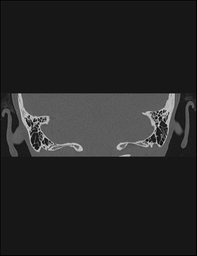 Aberrant right internal carotid artery (Radiopaedia 65191-74198 Coronal non-contrast 69).jpg
