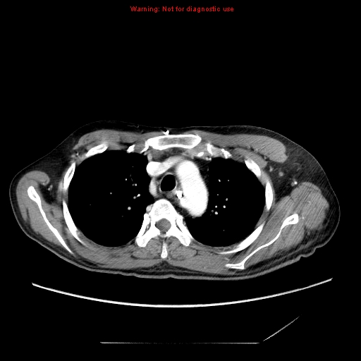 Aberrant right subclavian artery (Radiopaedia 9379-10071 Axial C+ arterial phase 19).jpg