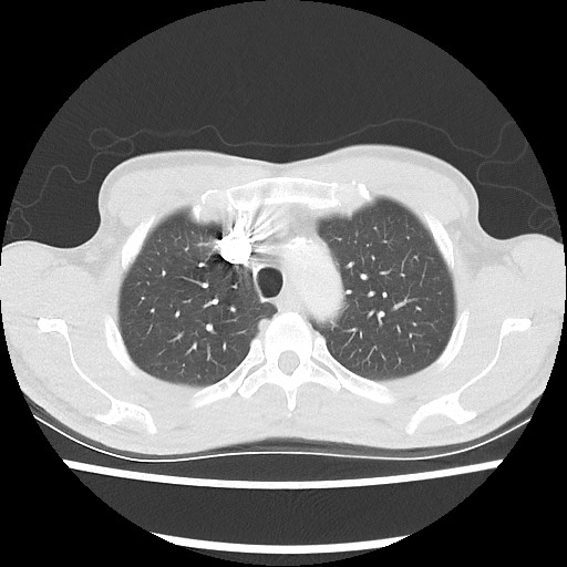 Accessory left horizontal fissure with lingular pneumonia (Radiopaedia 53763-59843 Axial lung window 15).jpg