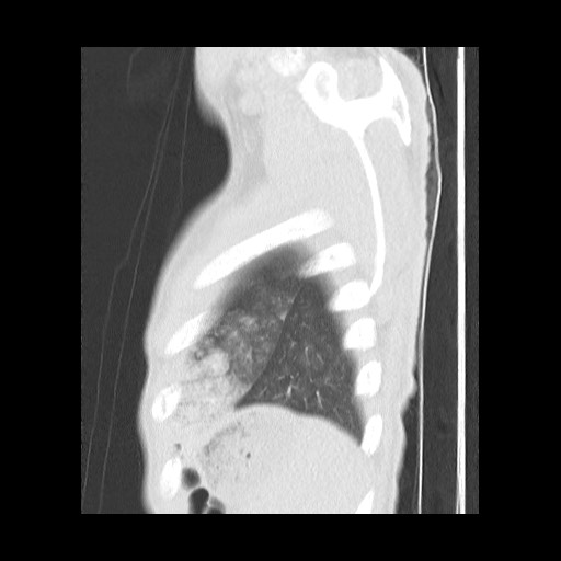 Accessory left horizontal fissure with lingular pneumonia (Radiopaedia 53763-59843 Sagittal lung window 61).jpg