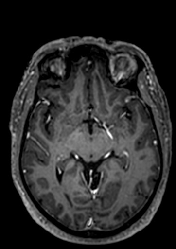 Accessory middle cerebral artery (Radiopaedia 73114-83828 Axial T1 C+ 57).jpg
