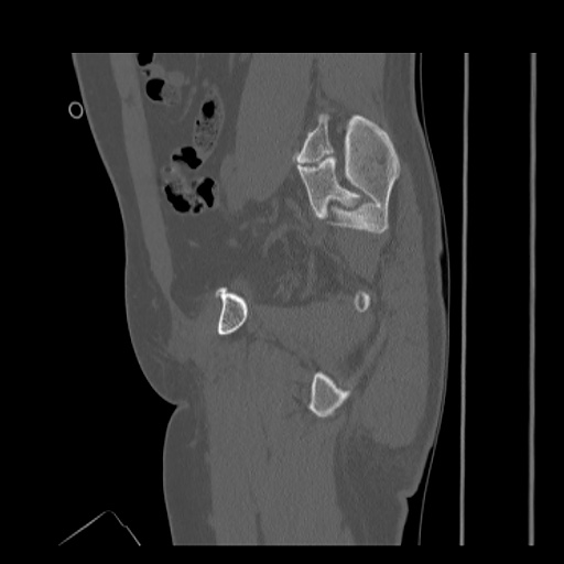 Acetabular and ilial fractures (Radiopaedia 59084-66378 Sagittal bone window 37).jpg