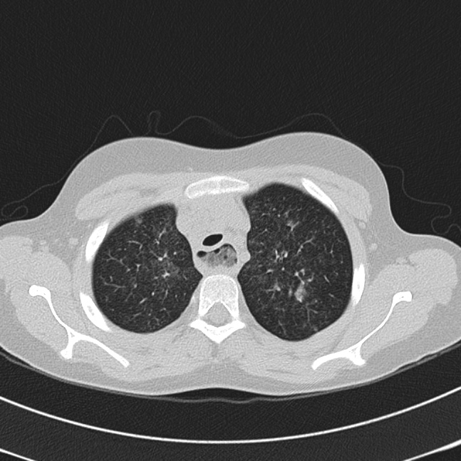 Achalasia (Radiopaedia 14946-14878 Axial lung window 13).jpg