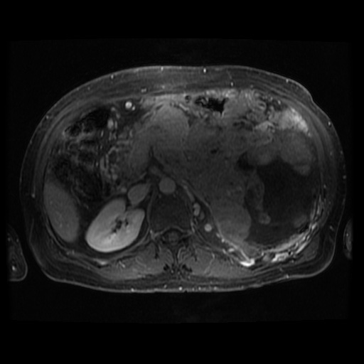 Acinar cell carcinoma of the pancreas (Radiopaedia 75442-86668 Axial T1 C+ fat sat 57).jpg
