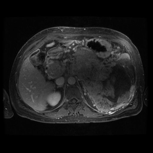 Acinar cell carcinoma of the pancreas (Radiopaedia 75442-86668 Axial T1 C+ fat sat 74).jpg