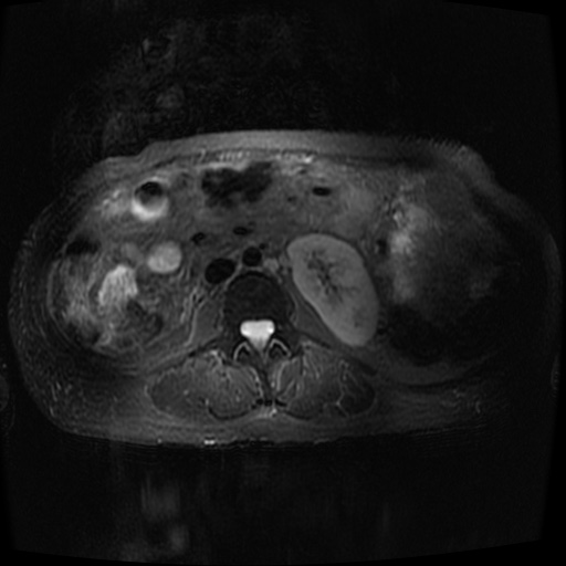 Acinar cell carcinoma of the pancreas (Radiopaedia 75442-86668 Axial T2 fat sat 49).jpg