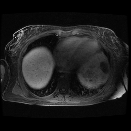 Acinar cell carcinoma of the pancreas (Radiopaedia 75442-86668 Axial late phase (~30 mins) 136).jpg