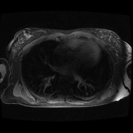 Acinar cell carcinoma of the pancreas (Radiopaedia 75442-86668 Axial late phase (~30 mins) 149).jpg