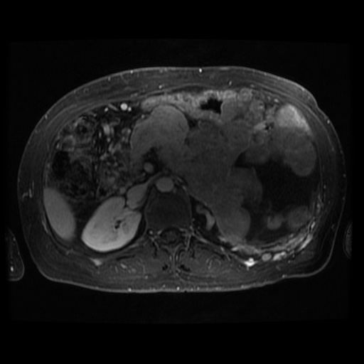 Acinar cell carcinoma of the pancreas (Radiopaedia 75442-86668 D 53).jpg