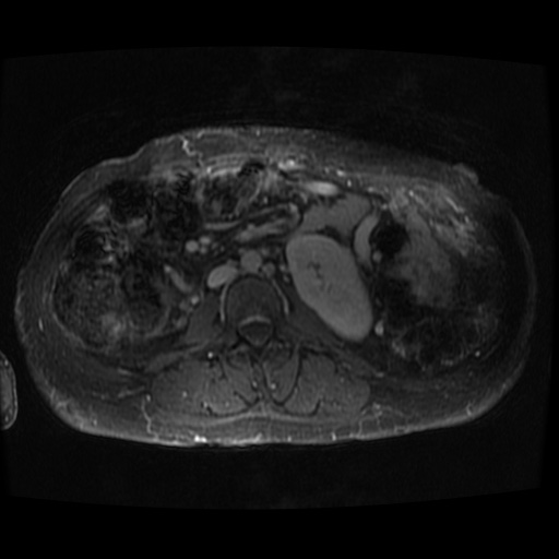 Acinar cell carcinoma of the pancreas (Radiopaedia 75442-86668 D 8).jpg