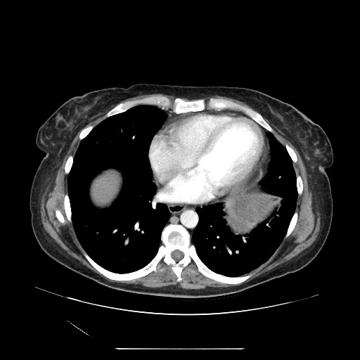 Acinar cell carcinoma of the pancreas (Radiopaedia 75442-86669 Axial C+ portal venous phase 4).jpg