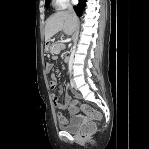 Acinar cell carcinoma of the pancreas (Radiopaedia 75442-86669 Sagittal C+ portal venous phase 93).jpg