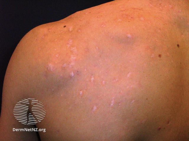 File:Acne affecting the back images (DermNet NZ acne-acne-back-150).jpg