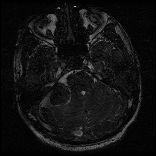 File:Acoustic schwannoma (Radiopaedia 39170-41387 Axial FIESTA 82).png