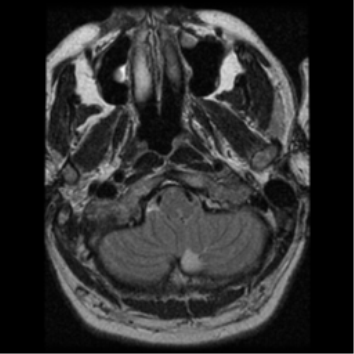 File:Acoustic schwannoma (Radiopaedia 39170-41387 Axial T2 2).png