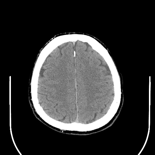 File:Acoustic schwannoma (Radiopaedia 39170-41388 Axial non-contrast 38).png