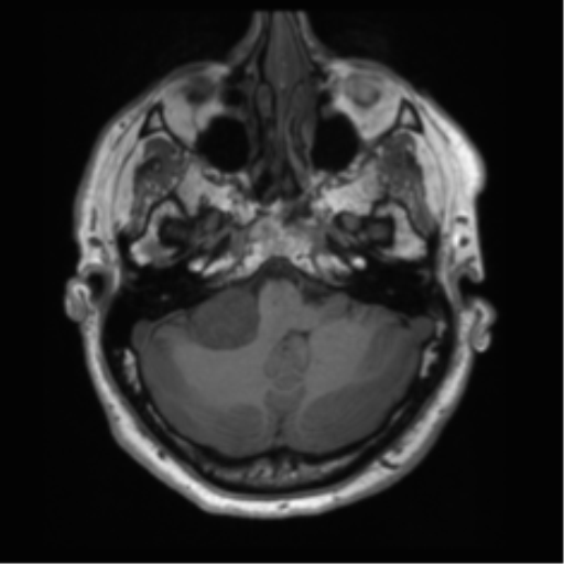 File:Acoustic schwannoma (Radiopaedia 50846-56358 Axial T1 16).png