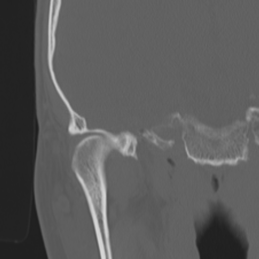 Acoustic schwannoma - eroding petrous apex (Radiopaedia 39674-42002 Coronal bone window 34).png