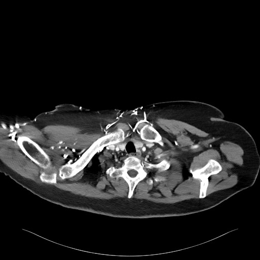 Acromioclavicular joint cyst (Radiopaedia 58455-65610 Axial C+ arterial phase 20).jpg