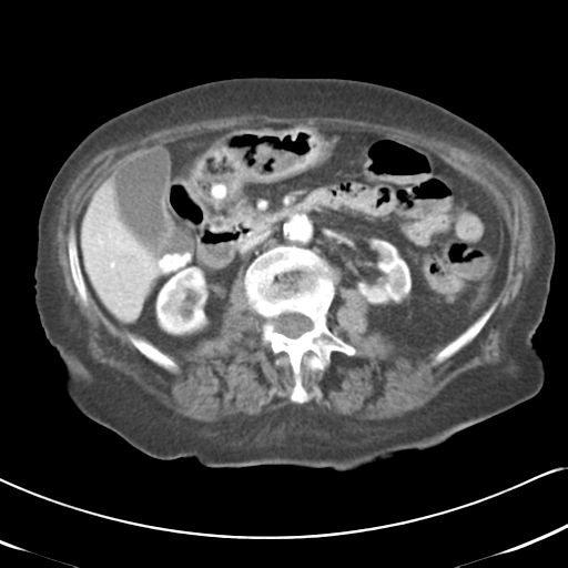 File:Active bleeding from duodenal ulcer with embolization (Radiopaedia 34216-35481 C 25).png
