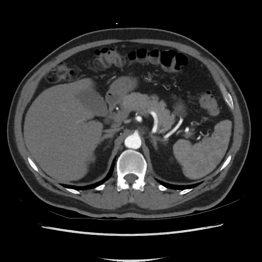 File:Active colonic bleed on CT (Radiopaedia 49765-55025 Axial C+ arterial phase 24).jpg