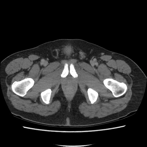 File:Active colonic bleed on CT (Radiopaedia 49765-55025 Axial C+ delayed 86).jpg