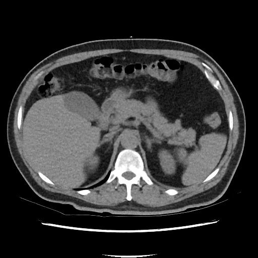 Active colonic bleed on CT (Radiopaedia 49765-55025 Axial non-contrast 21).jpg