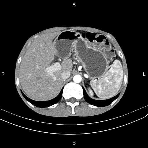 Active crohn disease (Radiopaedia 87133-103397 Axial C+ arterial phase 27).jpg