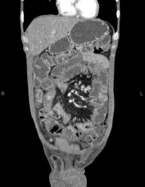 Active crohn disease (Radiopaedia 87133-103397 Coronal C+ arterial phase 13).jpg