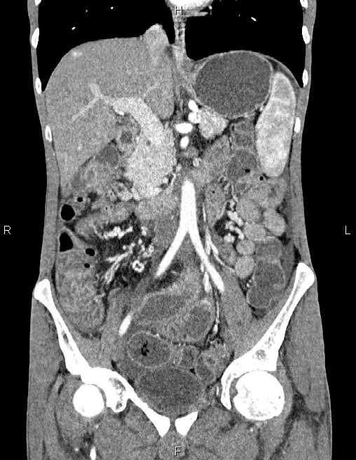 Active crohn disease (Radiopaedia 87133-103397 Coronal C+ arterial phase 30).jpg