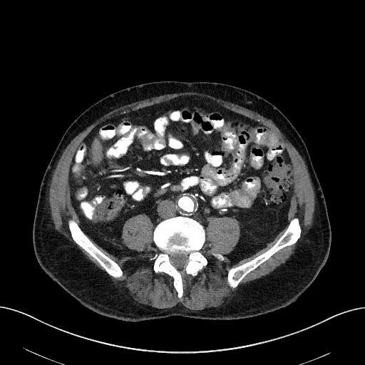 File:Active lower gastrointestinal bleeding - diverticular (Radiopaedia 61203-69106 Axial C+ arterial phase 7).jpg