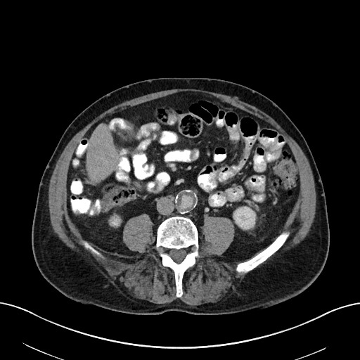 File:Active lower gastrointestinal bleeding - diverticular (Radiopaedia 61203-69106 Axial C+ portal venous phase 73).jpg