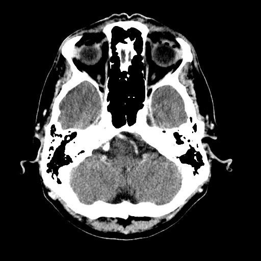 File:Active neurocysticercosis before and after therapy (Radiopaedia 71710-82099 Axial C+ delayed 83).jpg