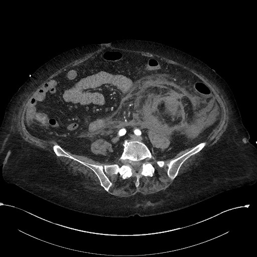 Active renal extravasation with large subcapsular and retroperitoneal hemorrhage (Radiopaedia 60975-68796 Axial C+ arterial phase 125).jpg