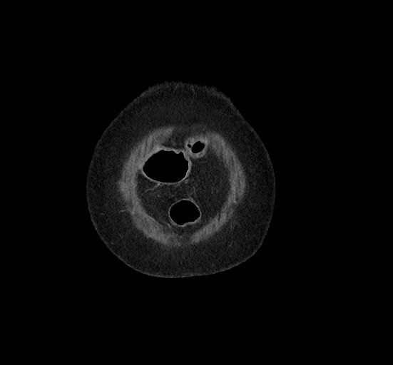Active renal extravasation with large subcapsular and retroperitoneal hemorrhage (Radiopaedia 60975-68796 Coronal C+ portal venous phase 17).jpg