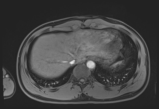 File:Active right ventricular cardiac sarcoidosis (Radiopaedia 55596-62100 Axial Post contrast Dixon 67).jpg