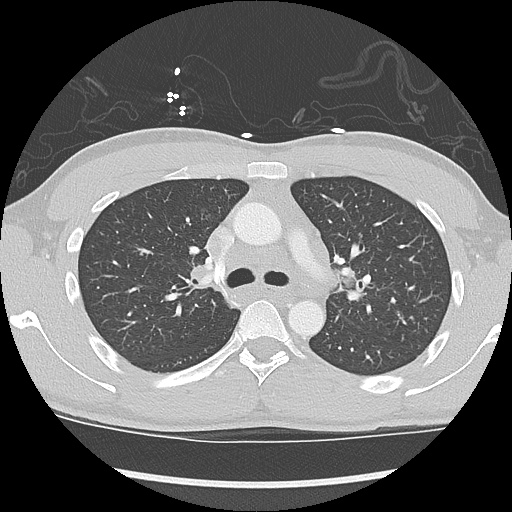File:Active right ventricular cardiac sarcoidosis (Radiopaedia 55596-62101 Axial lung window 13).jpg