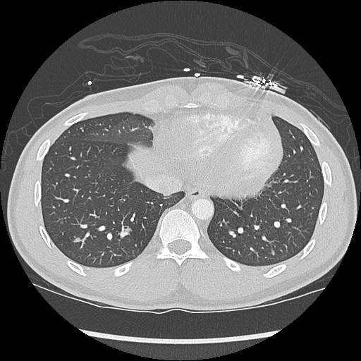 File:Active right ventricular cardiac sarcoidosis (Radiopaedia 55596-62101 Axial lung window 38).jpg