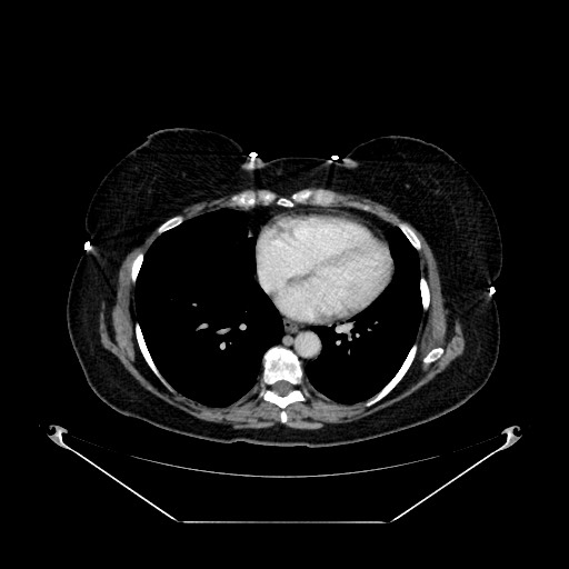 Acute appendicitis, heterotaxy syndrome (Radiopaedia 66884-76202 Axial C+ portal venous phase 6).jpg