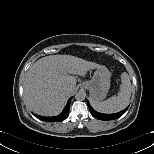 Acute appendicitis (Radiopaedia 58627-65818 Axial non-contrast 19).jpg