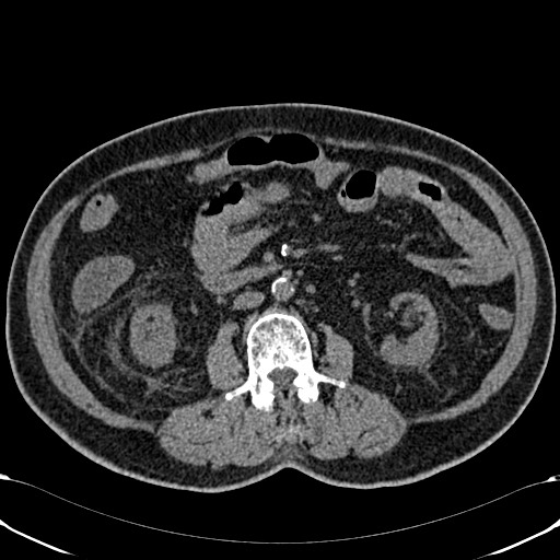 Acute appendicitis (Radiopaedia 58627-65818 Axial non-contrast 44).jpg