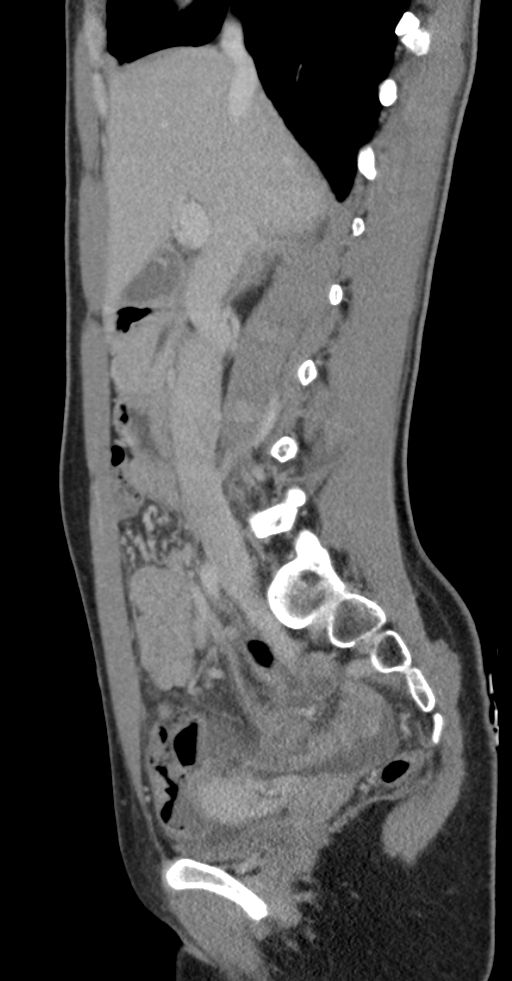 Acute appendicitis (Radiopaedia 62608-70901 Sagittal C+ portal venous phase 30).jpg