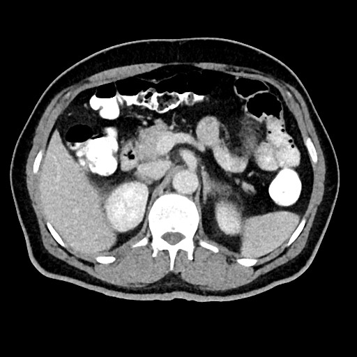 Acute appendicitis (Radiopaedia 77016-88960 Axial C+ portal venous phase 48).jpg