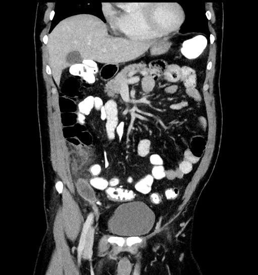File:Acute appendicitis (Radiopaedia 77016-88960 Coronal C+ portal venous phase 39).jpg